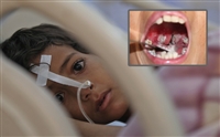 Yemen’de difteri salgını yüzlerce can aldı