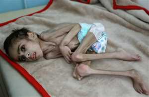 Yemen’de yetersiz beslenme çocukları öldürüyor