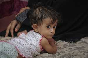 الإعلان عن علاج 2255 طفلا مصابا بسوء التغذية في اليمن