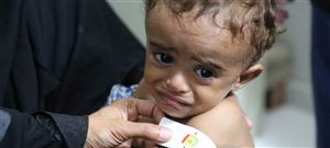 الصحة العالمية: أكثر من 2 مليون طفل يمني بحاجة إلى علاج سوء التغذية الحاد