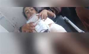 إصابة طفلة برصاص قناص مليشيات الحوثي غربي الضالع