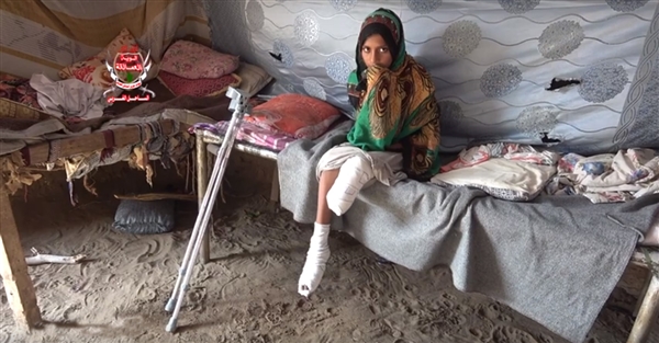 ألغام الموت الحوثية تحرم طفلة في عمر الزهور من قدميها في الحديدة