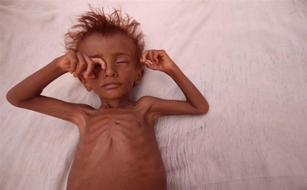 وفاة طفل تحت سن الخامسة كل 12 دقيقة باليمن‎ (مسؤول أممي)