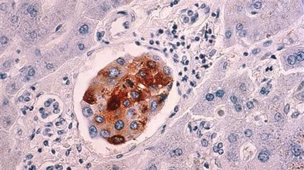 تطوير فيروس قادر على قتل كل أنواع السرطان.. لكنه قد يهدد الحياة