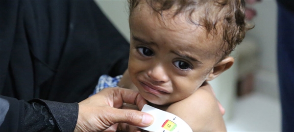الصحة العالمية: 320 ألف طفل يمني يعانون سوء التغذية