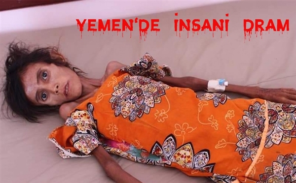 Yemen’de yetersiz beslenme ve açlığın fotoğrafı