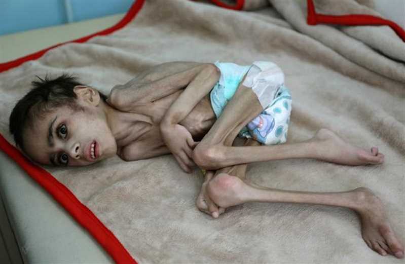 Yemen’de yetersiz beslenme çocukları öldürüyor