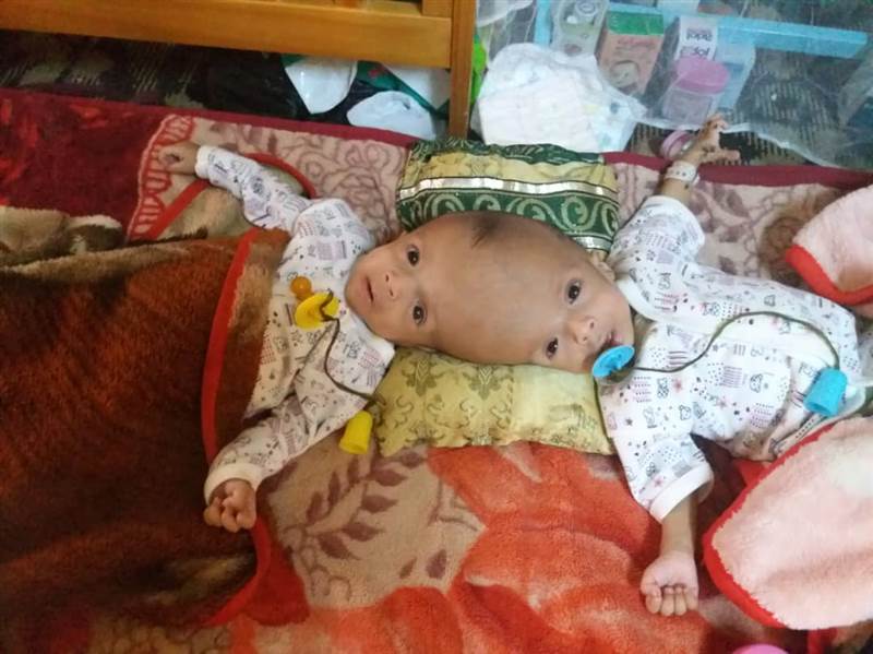 أسرة في حضرموت تناشد الحكومة إنقاذ طفليها " الملتصقان " وتسفيرهما للعلاج في الخارج