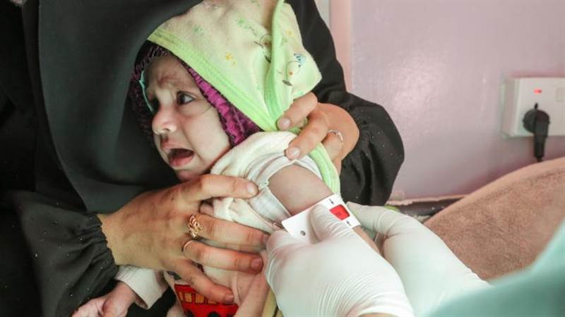 الأمم المتحدة:سوء التغذية الحاد يهدد نصف الأطفال دون سن الخامسة في اليمن