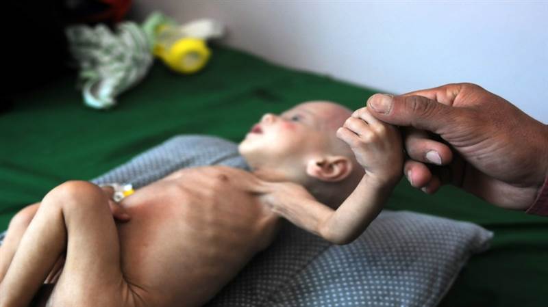 Husilerin kuşattığı Taiz’de yetersiz beslenme çocukları tehdit ediyor