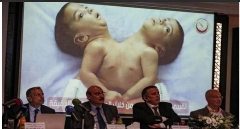 Yemenli yapışık ikizler 8 saatlik operasyonla ayrıldı