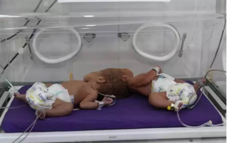 Yemenli siyam ikizler Suudi Kralı’nın talimatı ile Riyad’a yapılacak ameliyatla ayrılacak