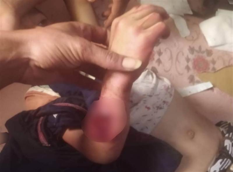 إصابة طفل بنيران حوثية في محافظة تعز