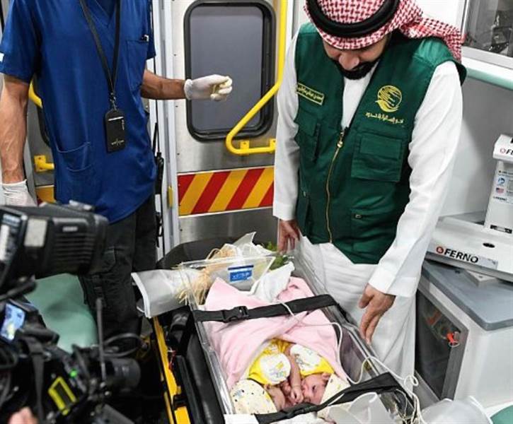 Yemenli siyam ikizler Suudi Arabistan’da gerçekleştirilen başarılı ameliyatla ayrıldı