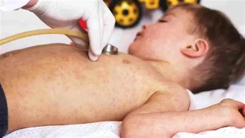 فيروس مرض الحصبة يفتك بأرواح الأطفال في محافظة شبوة
