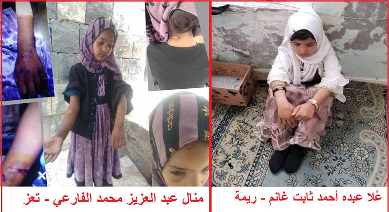 في حادثتين منفصلتين.. تعرض طفلتين للتعذيب على يد زوجتي والديهن في محافظتي تعز وريمة (تقرير طبي)