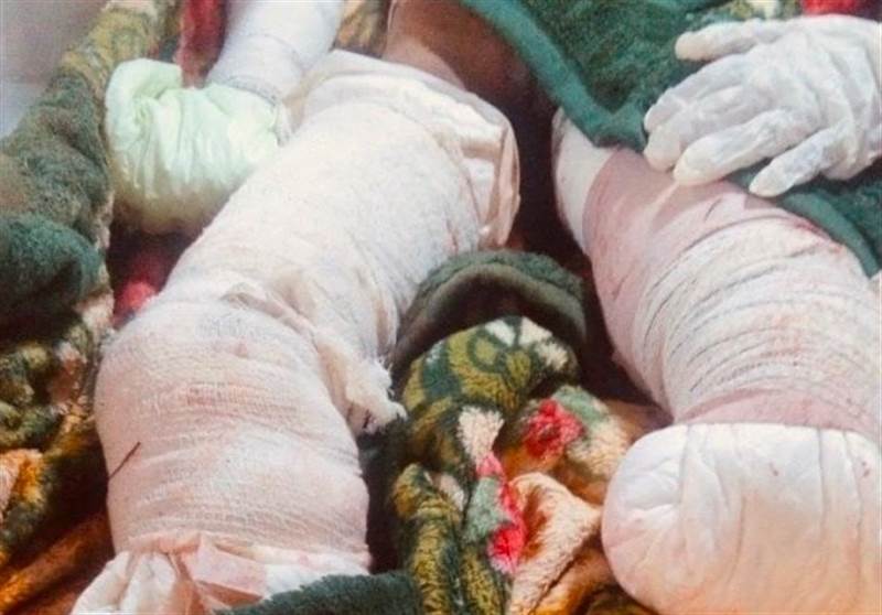 Yemen’in Hacce kentide Husilerin döşediği mayının patlaması sonucu bir çocuk ağır yaralandı