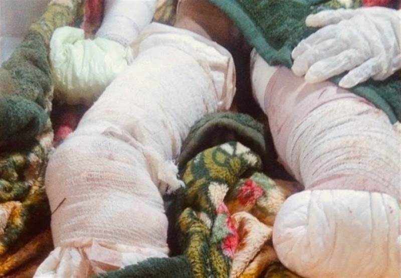 انفجار لغم حوثي يتسبب ببتر قدمي ويد طفل في محافظة حجة