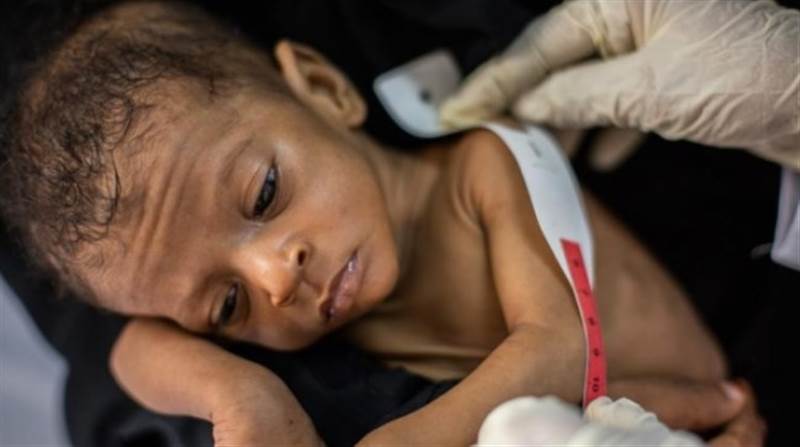 İngiltere: Yemen'deki çocukların yarısı yetersiz beslenmeden dolayı bodur kalıyor
