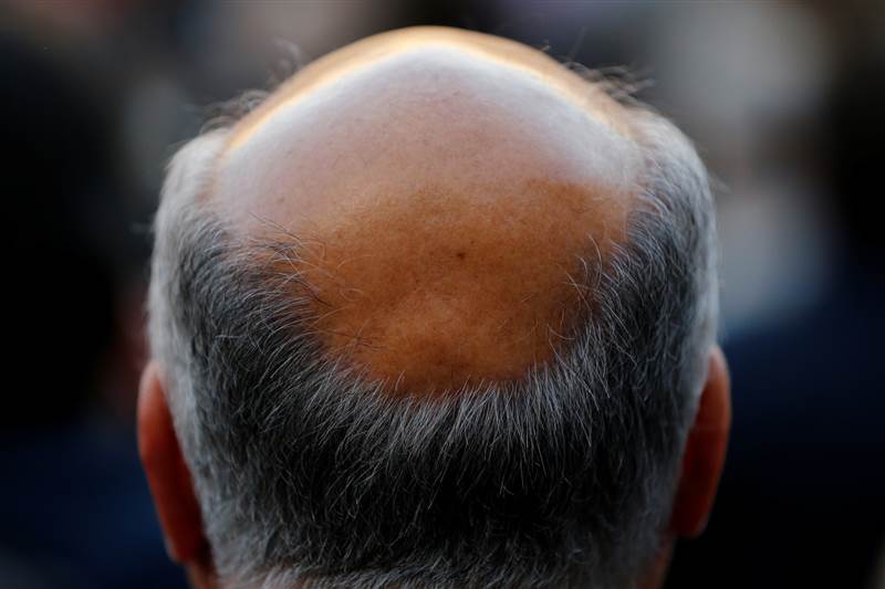 اختراق علمي واعد في علاج الصلع: جزيء جديد يعزز نمو الشعر بأمان