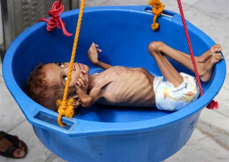 الازمة الغذائية في اليمن تتفاقم بصورة مخيفة و17 مليون جائع في سباق مع الانهيار
